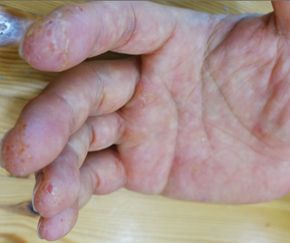 평택 습진 치료 경과 — 49세   남성 · 치료 전
