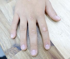 평택 사마귀 치료 경과 — 13세 남 · 치료 전