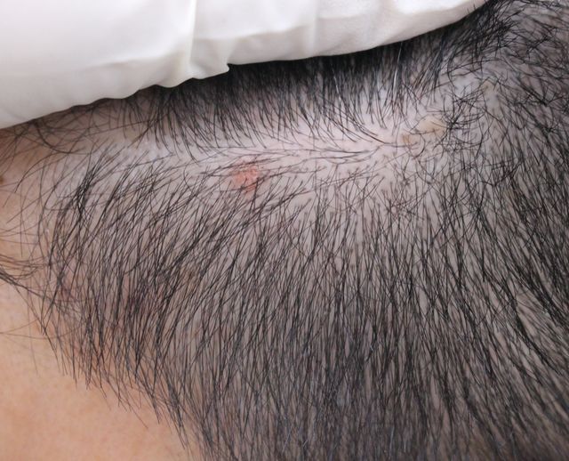 평택 사마귀 치료 경과 — 34세 남성 · 치료 전