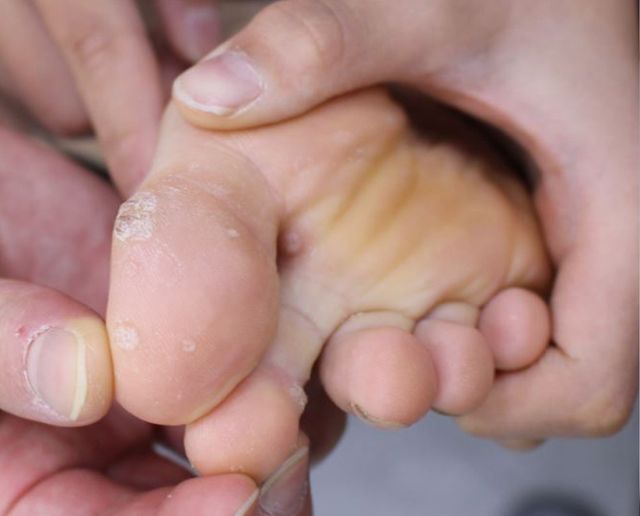 평택 사마귀 치료 경과 — 10세 남 · 치료 전