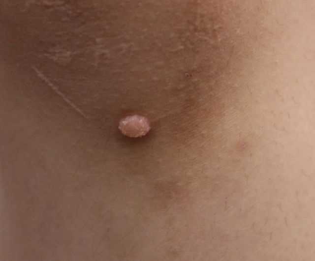 평택 사마귀 치료 경과 — 21세 여성 · 치료 전